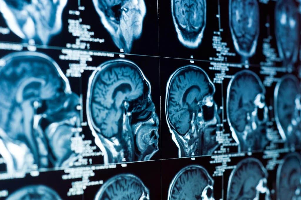 Erin Marshall Law | Stroke Timeline: Why Time Is Critical For Treatment