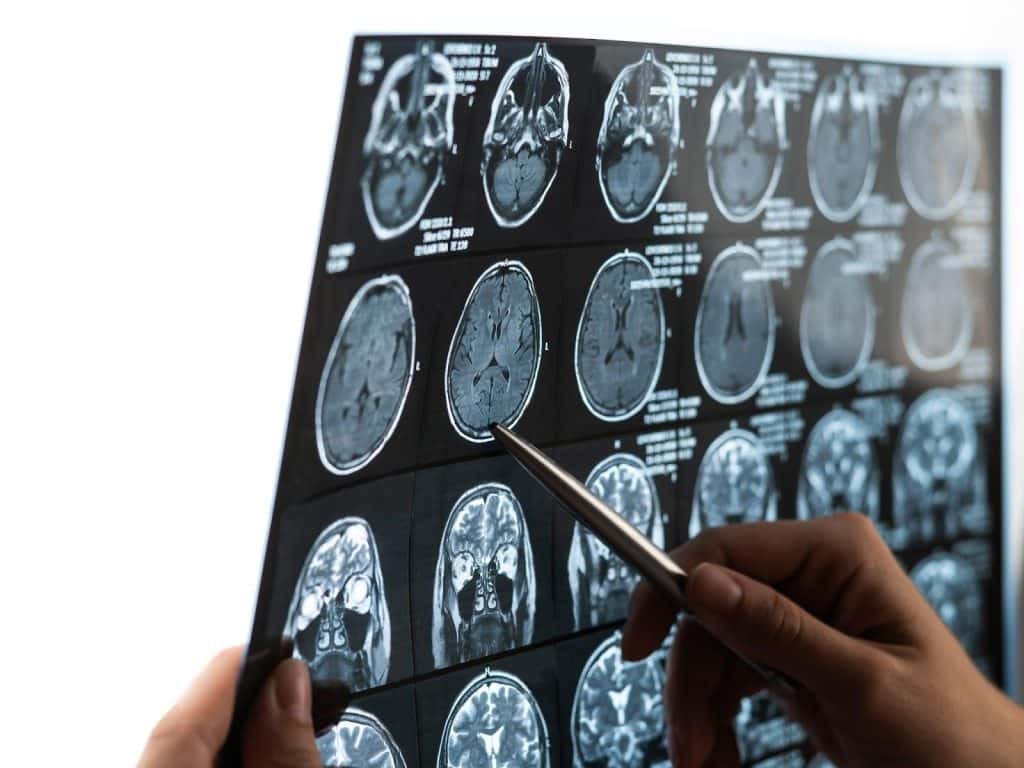 Erin Marshall Law | Medical Negligence In Acute Stroke Treatment