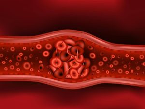 Erin Marshall Law | Medical Negligence In Preventing Blood Clots In Women
