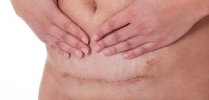 Erin Marshall Law | Gyn Surgery Infections: What Happens When An Infection Goes Undiagnosed Erin Marshall Law | Gyn Surgery Infections: What Happens When An Infection Goes Undiagnosed